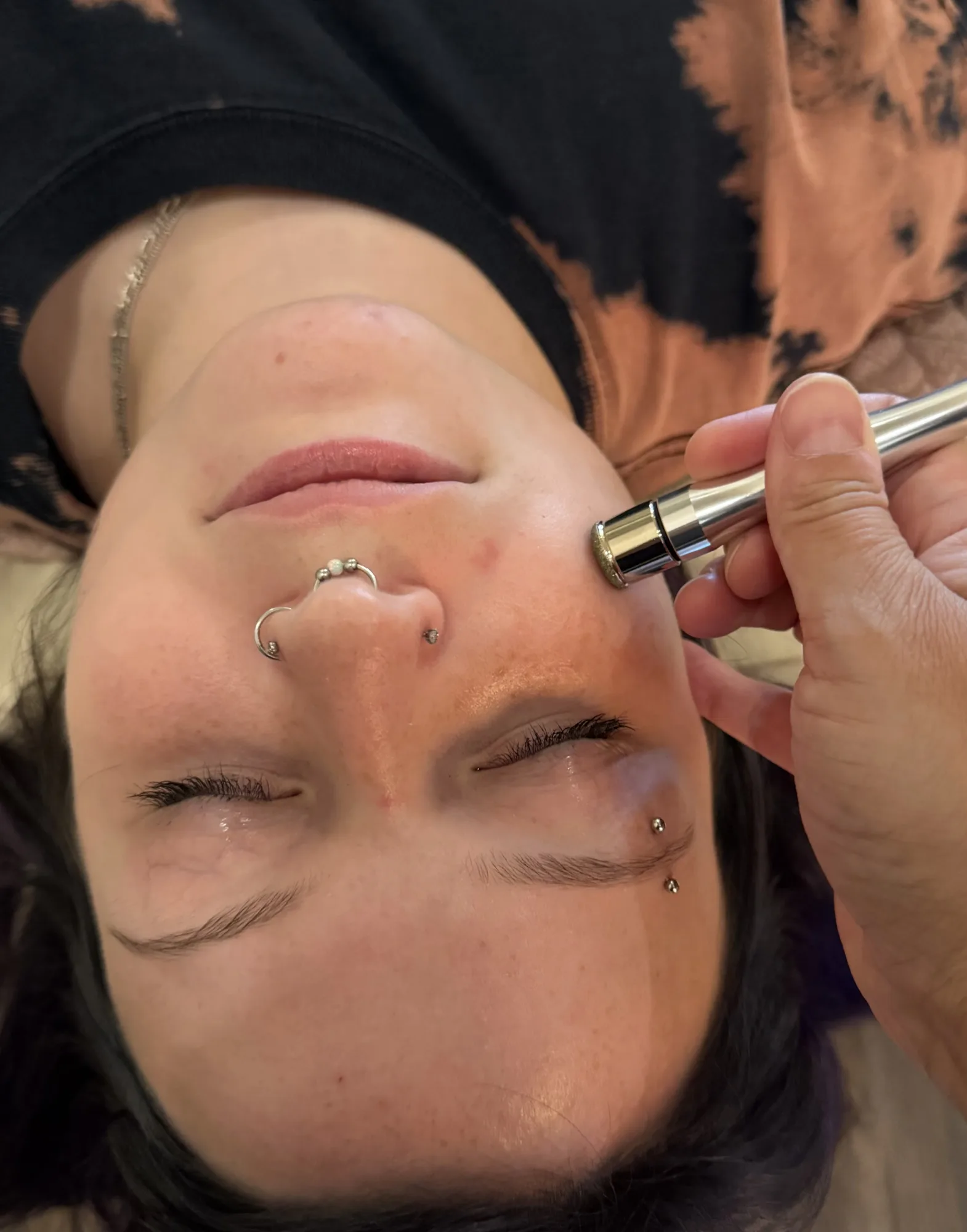 Microdermabrasion